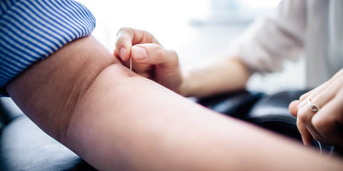 Dry needling